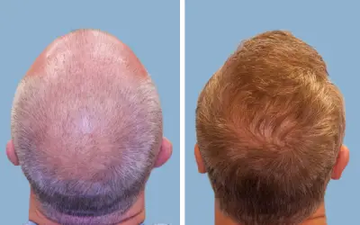 Before and After